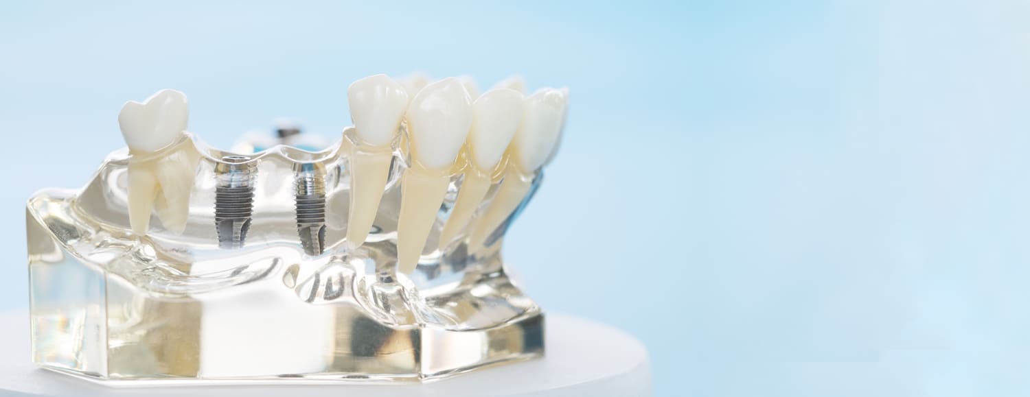 Implantes dentales para una sonrisa natural
